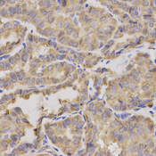 XRCC2 Antibody - Immunohistochemistry of paraffin-embedded human thyroid cancer using XRCC2 antibodyat dilution of 1:200 (40x lens).