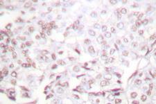 XRCC2 Antibody - IHC of XRCC2 (F240) pAb in paraffin-embedded human lung carcinoma tissue.