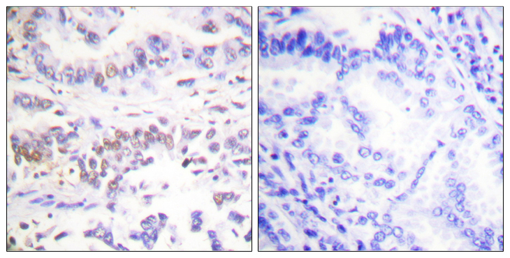 XRCC3 Antibody - Immunohistochemistry analysis of paraffin-embedded human lung carcinoma tissue, using XRCC3 Antibody. The picture on the right is blocked with the synthesized peptide.