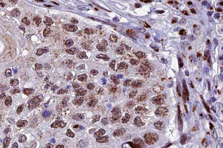 XRCC3 Antibody - 1:100 staining human lung carcinoma tissue by IHC-P. The tissue was formaldehyde fixed and a heat mediated antigen retrieval step in citrate buffer was performed. The tissue was then blocked and incubated with the antibody for 1.5 hours at 22°C. An HRP conjugated goat anti-rabbit antibody was used as the secondary.