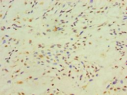 XRCC4 Antibody - Immunohistochemistry of paraffin-embedded human breast cancer using antibody at 1:100 dilution.