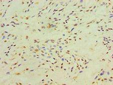 XRCC4 Antibody - Immunohistochemistry of paraffin-embedded human breast cancer using antibody at 1:100 dilution.