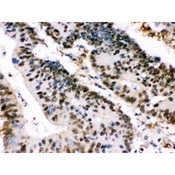 XRCC4 Antibody - XRCC4 was detected in paraffin-embedded sections of human intestinal cancer tissues using rabbit anti- XRCC4 Antigen Affinity purified polyclonal antibody at 1 ug/mL. The immunohistochemical section was developed using SABC method.