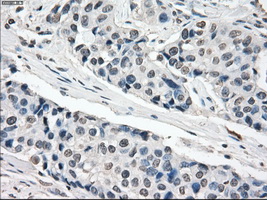 XRCC4 Antibody - IHC of paraffin-embedded Adenocarcinoma of breast tissue using anti-XRCC4 mouse monoclonal antibody. (Dilution 1:50).