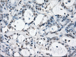 XRCC4 Antibody - IHC of paraffin-embedded Adenocarcinoma of colon tissue using anti-XRCC4 mouse monoclonal antibody. (Dilution 1:50).