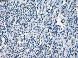 XRCC4 Antibody - IHC of paraffin-embedded Carcinoma of thyroid tissue using anti-XRCC4 mouse monoclonal antibody. (Dilution 1:50).