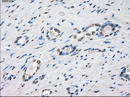 XRCC4 Antibody - IHC of paraffin-embedded Carcinoma of prostate tissue using anti-XRCC4 mouse monoclonal antibody. (Dilution 1:50).