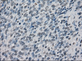 XRCC4 Antibody - IHC of paraffin-embedded Carcinoma of bladder tissue using anti-XRCC4 mouse monoclonal antibody. (Dilution 1:50).