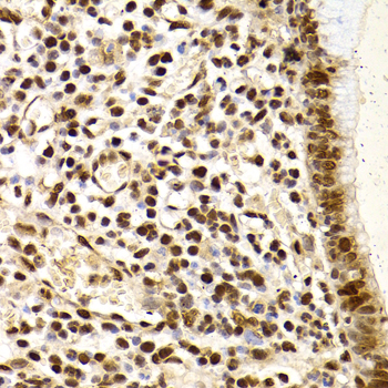 XRCC4 Antibody - Immunohistochemistry of paraffin-embedded human gastric cancer using XRCC4 Antibodyat dilution of 1:200 (40x lens).