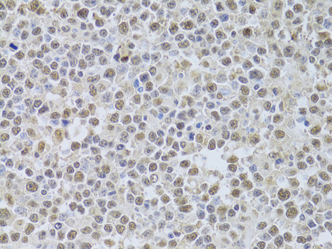 XRCC4 Antibody - Immunohistochemistry of paraffin-embedded human B cell lymphoma using XRCC4 Antibodyat dilution of 1:100 (40x lens).