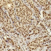 XRCC4 Antibody - Immunohistochemical analysis of XRCC4 staining in human breast cancer formalin fixed paraffin embedded tissue section. The section was pre-treated using heat mediated antigen retrieval with sodium citrate buffer (pH 6.0). The section was then incubated with the antibody at room temperature and detected using an HRP conjugated compact polymer system. DAB was used as the chromogen. The section was then counterstained with hematoxylin and mounted with DPX.