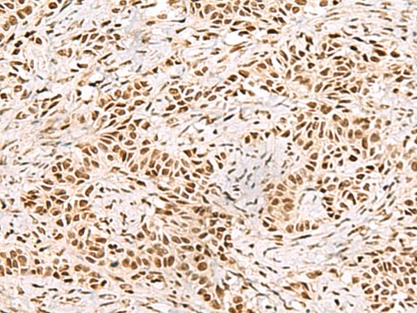 XRCC4 Antibody - Immunohistochemistry of paraffin-embedded Human ovarian cancer tissue  using XRCC4 Polyclonal Antibody at dilution of 1:60(×200)
