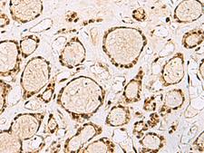 XRCC4 Antibody - Immunohistochemistry of paraffin-embedded Human thyroid cancer tissue  using XRCC4 Polyclonal Antibody at dilution of 1:60(×200)
