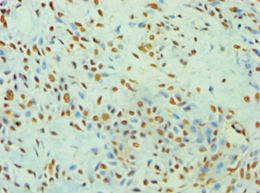 XRCC5 / Ku80 Antibody - Immunohistochemistry of paraffin-embedded human breast cancer using antibody at 1:100 dilution.