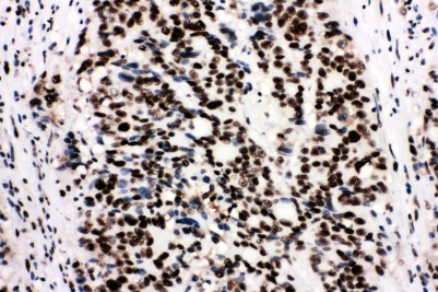 XRCC5 / Ku80 Antibody - XRCC5 / Ku80 antibody. IHC(P):Human Breast Cancer Tissue.