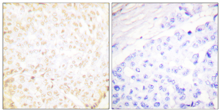 XRCC5 / Ku80 Antibody - Immunohistochemistry analysis of paraffin-embedded human breast carcinoma tissue, using XRCC5 Antibody. The picture on the right is blocked with the synthesized peptide.