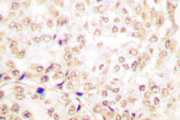 XRCC5 / Ku80 Antibody - IHC of XRCC5 (A717) pAb in paraffin-embedded human breast carcinoma tissue.