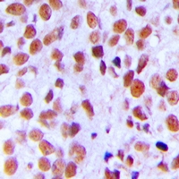 XRCC5 / Ku80 Antibody - Immunohistochemical analysis of Ku80 (pT714) staining in human breast cancer formalin fixed paraffin embedded tissue section. The section was pre-treated using heat mediated antigen retrieval with sodium citrate buffer (pH 6.0). The section was then incubated with the antibody at room temperature and detected with HRP and DAB as chromogen. The section was then counterstained with hematoxylin and mounted with DPX.