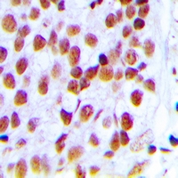 XRCC5 / Ku80 Antibody - Immunohistochemical analysis of Ku80 staining in human breast cancer formalin fixed paraffin embedded tissue section. The section was pre-treated using heat mediated antigen retrieval with sodium citrate buffer (pH 6.0). The section was then incubated with the antibody at room temperature and detected using an HRP polymer system. DAB was used as the chromogen. The section was then counterstained with hematoxylin and mounted with DPX.