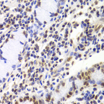 XRCC5 / Ku80 Antibody - Immunohistochemistry of paraffin-embedded Human gastric cancer tissue.