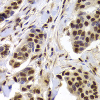 XRCC5 / Ku80 Antibody - Immunohistochemistry of paraffin-embedded Human mammary cancer tissue.