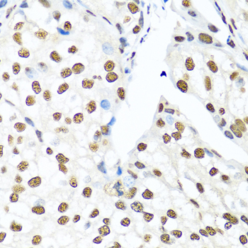XRCC5 / Ku80 Antibody - Immunohistochemistry of paraffin-embedded human prostate cancer tissue.