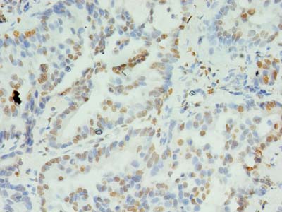 XRCC5 / Ku80 Antibody - Immunohistochemistry of paraffin-embedded human lung cancer using antibody at dilution of 1:100.