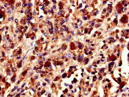 XRCC5 / Ku80 Antibody - Immunohistochemistry of paraffin-embedded human melanoma cancer using XRCC5 Antibody at dilution of 1:100