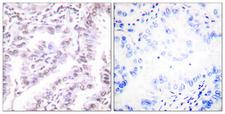 XRCC5 / Ku80 Antibody - Peptide - + Immunohistochemical analysis of paraffin-embedded human lung carcinoma tissue using Ku80 (Ab-714) Antibody.