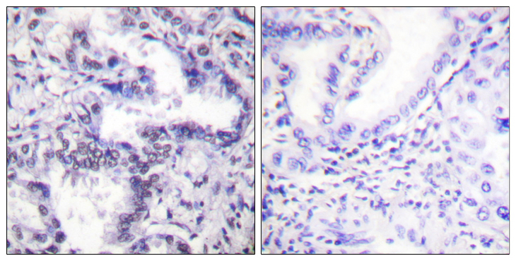 XRCC5 / Ku80 Antibody - Immunohistochemistry analysis of paraffin-embedded human lung carcinoma, using Ku80 (Phospho-Thr714) Antibody. The picture on the right is blocked with the phospho peptide.