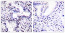 XRCC5 / Ku80 Antibody - Immunohistochemistry analysis of paraffin-embedded human lung carcinoma, using Ku80 (Phospho-Thr714) Antibody. The picture on the right is blocked with the phospho peptide.