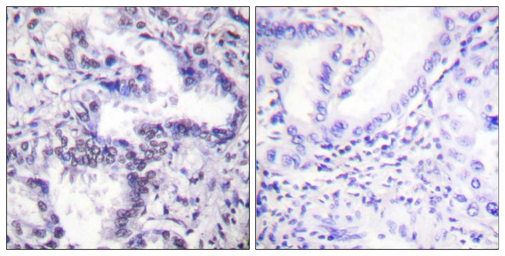 XRCC5 / Ku80 Antibody - P-peptide - + Immunohistochemical analysis of paraffin-embedded human lung carcinoma tissue using Ku80 (Phospho-Thr714) Antibody.