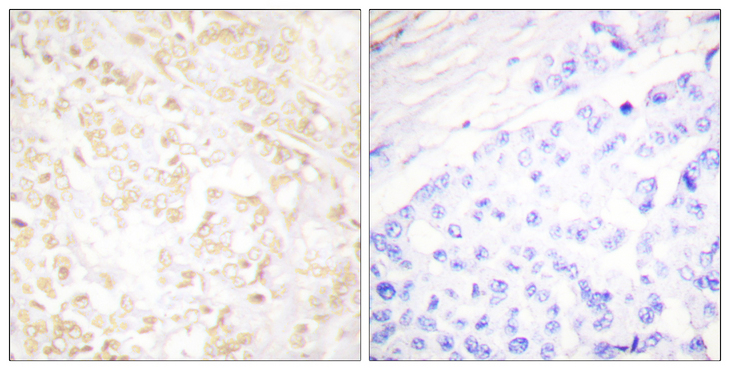 XRCC6 / Ku70 Antibody - Immunohistochemistry analysis of paraffin-embedded human breast carcinoma tissue, using XRCC6 Antibody. The picture on the right is blocked with the synthesized peptide.
