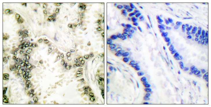 XRCC6 / Ku70 Antibody - Immunohistochemistry analysis of paraffin-embedded human lung carcinoma tissue, using Ku70 Antibody. The picture on the right is blocked with the synthesized peptide.