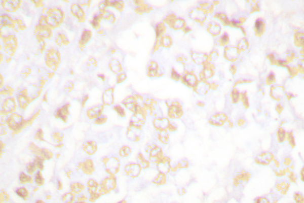 XRCC6 / Ku70 Antibody - IHC of XRCC6 (R586) pAb in paraffin-embedded human breast carcinoma tissue.