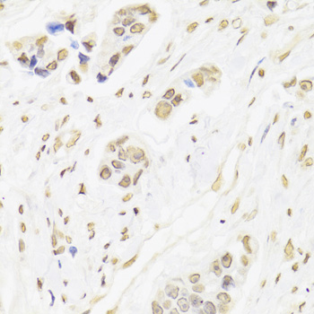 XRCC6 / Ku70 Antibody - Immunohistochemistry of paraffin-embedded human breast cancer using XRCC6 Antibodyat dilution of 1:100 (40x lens).