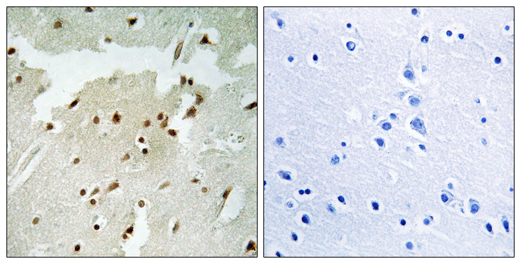 XRCC6 / Ku70 Antibody - Immunohistochemistry analysis of paraffin-embedded human lung carcinoma, using Ku70 (Phospho-Ser5) Antibody. The picture on the right is blocked with the phospho peptide.