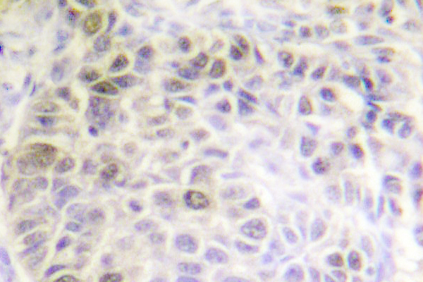 XRCC6 / Ku70 Antibody - IHC of Ku70 (S1) pAb in paraffin-embedded human liver carcinoma tissue.