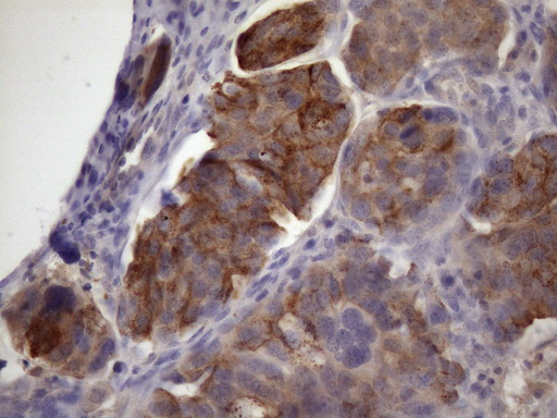 XRCC6BP1 Antibody - Immunohistochemical staining of paraffin-embedded Adenocarcinoma of Human ovary tissue using anti-XRCC6BP1 mouse monoclonal antibody. (Heat-induced epitope retrieval by 1mM EDTA in 10mM Tris buffer. (pH8.5) at 120 oC for 3 min. (1:150)