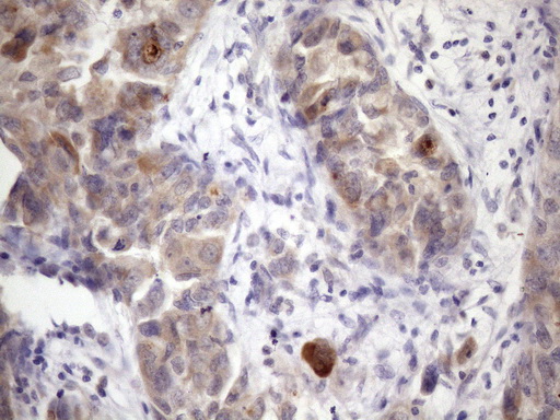 XRCC6BP1 Antibody - Immunohistochemical staining of paraffin-embedded Adenocarcinoma of Human endometrium tissue using anti-XRCC6BP1 mouse monoclonal antibody. (Heat-induced epitope retrieval by 1mM EDTA in 10mM Tris buffer. (pH8.5) at 120 oC for 3 min. (1:150)
