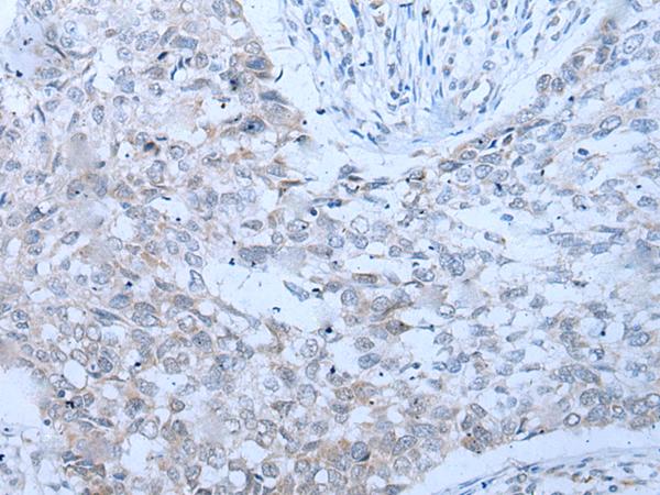 XRN1 Antibody - Immunohistochemistry of paraffin-embedded Human lung cancer tissue  using XRN1 Polyclonal Antibody at dilution of 1:25(×200)