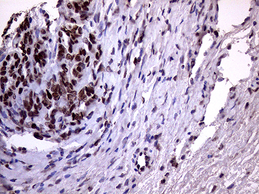 XRN2 Antibody - Immunohistochemical staining of paraffin-embedded Adenocarcinoma of Human ovary tissue using anti-XRN2 mouse monoclonal antibody. (Heat-induced epitope retrieval by 1mM EDTA in 10mM Tris buffer. (pH8.5) at 120°C for 3 min. (1:2000)