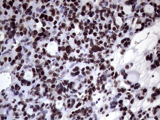 XRN2 Antibody - Immunohistochemical staining of paraffin-embedded Carcinoma of Human thyroid tissue using anti-XRN2 mouse monoclonal antibody. (Heat-induced epitope retrieval by 1mM EDTA in 10mM Tris buffer. (pH8.5) at 120°C for 3 min. (1:2000)