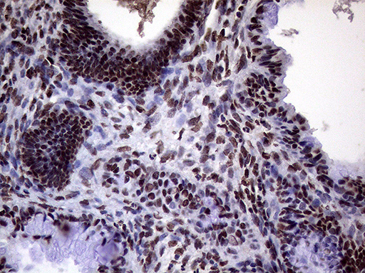 XRN2 Antibody - Immunohistochemical staining of paraffin-embedded Adenocarcinoma of Human endometrium tissue using anti-XRN2 mouse monoclonal antibody. (Heat-induced epitope retrieval by 1mM EDTA in 10mM Tris buffer. (pH8.5) at 120°C for 3 min. (1:2000)