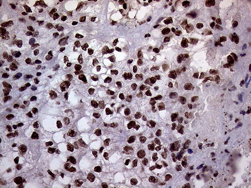 XRN2 Antibody - Immunohistochemical staining of paraffin-embedded Carcinoma of Human kidney tissue using anti-XRN2 mouse monoclonal antibody. (Heat-induced epitope retrieval by 1mM EDTA in 10mM Tris buffer. (pH8.5) at 120°C for 3 min. (1:2000)