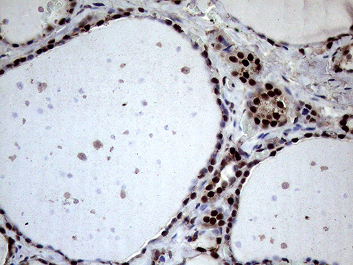 XRN2 Antibody - Immunohistochemical staining of paraffin-embedded Human thyroid tissue within the normal limits using anti-XRN2 mouse monoclonal antibody. (Heat-induced epitope retrieval by 1mM EDTA in 10mM Tris buffer. (pH8.5) at 120°C for 3 min. (1:2000)