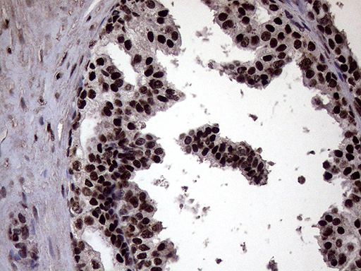 XRN2 Antibody - Immunohistochemical staining of paraffin-embedded Carcinoma of Human prostate tissue using anti-XRN2 mouse monoclonal antibody. (Heat-induced epitope retrieval by 1mM EDTA in 10mM Tris buffer. (pH8.5) at 120°C for 3 min. (1:2000)