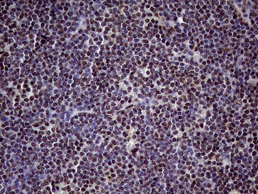 XRN2 Antibody - Immunohistochemical staining of paraffin-embedded Human lymphoma tissue using anti-XRN2 mouse monoclonal antibody. (Heat-induced epitope retrieval by 1mM EDTA in 10mM Tris buffer. (pH8.5) at 120°C for 3 min. (1:2000)