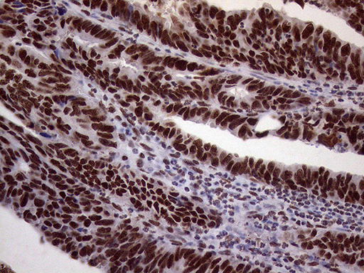 XRN2 Antibody - Immunohistochemical staining of paraffin-embedded Adenocarcinoma of Human colon tissue using anti-XRN2 mouse monoclonal antibody. (Heat-induced epitope retrieval by 1mM EDTA in 10mM Tris buffer. (pH8.5) at 120°C for 3 min. (1:2000)