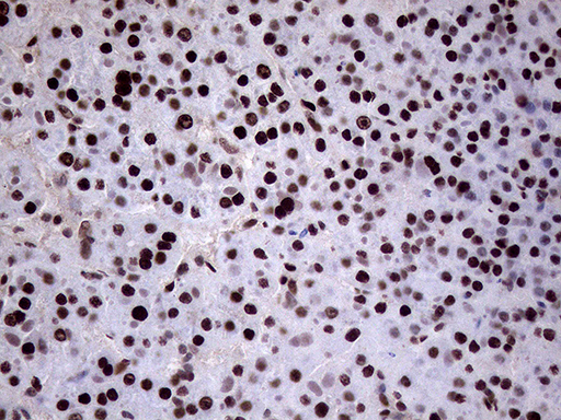 XRN2 Antibody - Immunohistochemical staining of paraffin-embedded Carcinoma of Human liver tissue using anti-XRN2 mouse monoclonal antibody. (Heat-induced epitope retrieval by 1mM EDTA in 10mM Tris buffer. (pH8.5) at 120°C for 3 min. (1:2000)